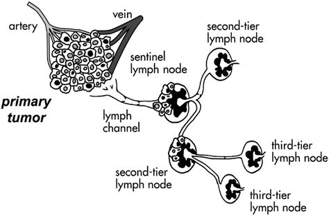 Sentinel Lymph Node Biopsy .